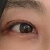 一个单眼皮女生 面对双眼皮修复的过程
