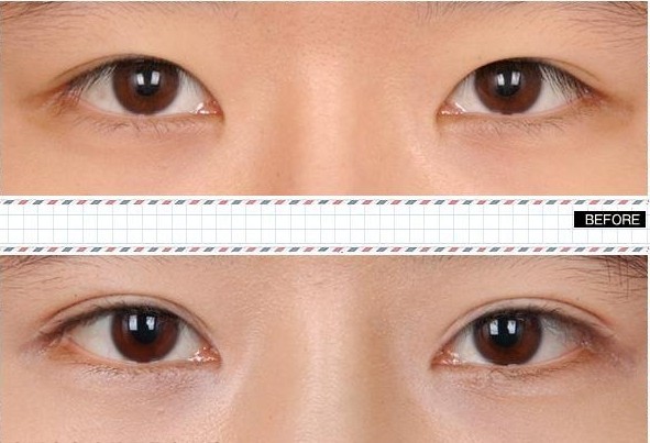 双眼皮手术效果图