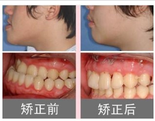 宜春天泽医院天包地牙齿矫正的价格介绍