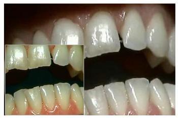 迅速成为了消费者牙齿美白的首选.