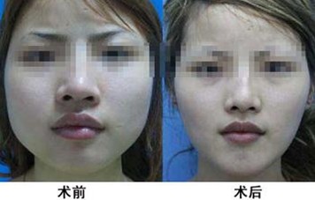 瘦脸针对比图
