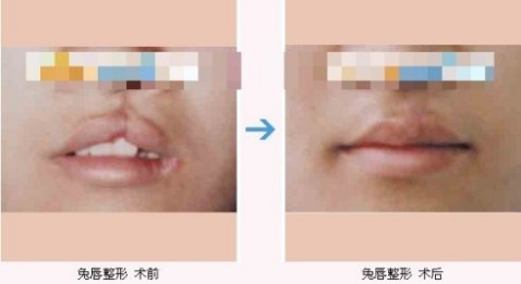 唇腭裂修复术对比图