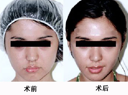 咸阳彩虹医院美容科去咬肌瘦脸对比图