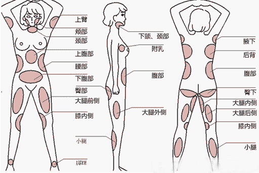 选择抽脂的部位会影响全身吸脂的费用吗