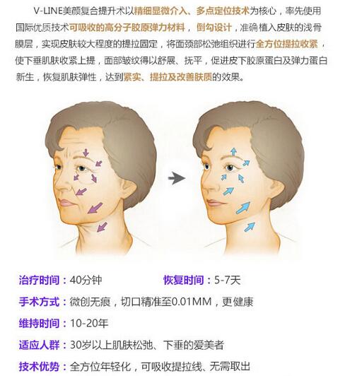 河南整形医院V-LINE美颜复合提升术