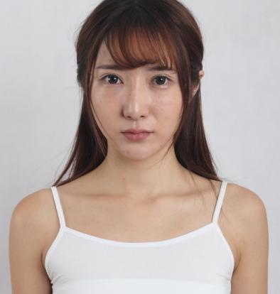 无痕隆胸案例:胸很软很自然
