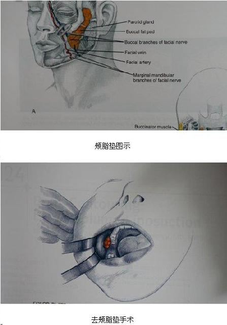 去颊脂垫后就能有椭圆形脸型了吗_去面颊部脂肪垫术