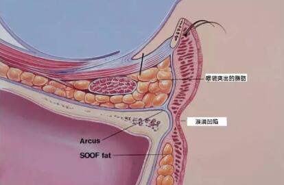 眼泪痕沟的形成原因及解决方法