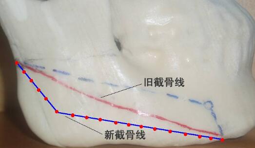 什么年龄适合做颌角截骨手术