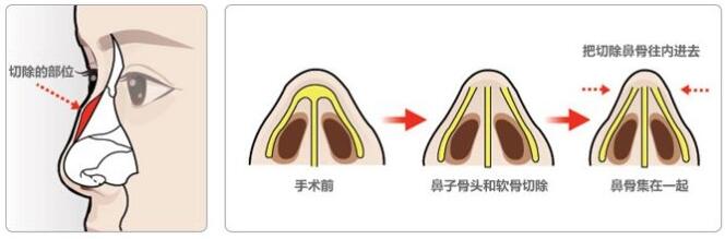 鹰钩鼻矫正术的麻醉情况如何