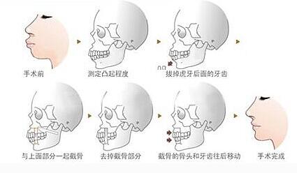 正颌尊龙凯时手术能与面部轮廓手术同时进行吗