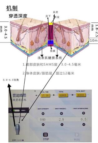 做雷达面部轮廓手术治疗时是否有疼痛