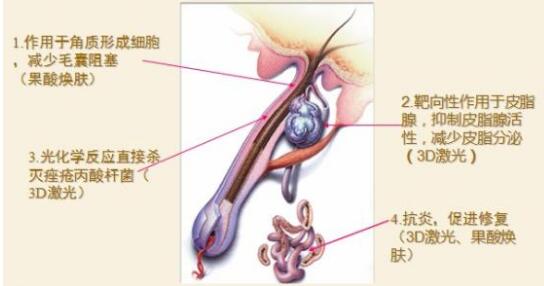 激光祛痘皮肤会变薄吗