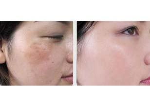 彩光祛斑的禁忌症是什么