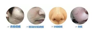 激光去脸上疤痕的价格在多少范围