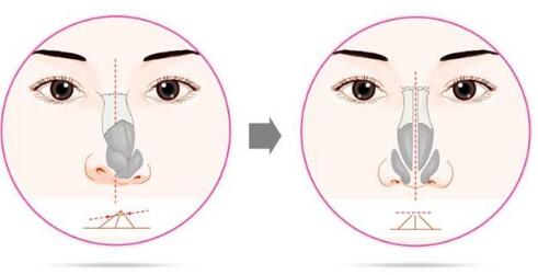 歪鼻矫正手术切口在鼻腔内完成吗