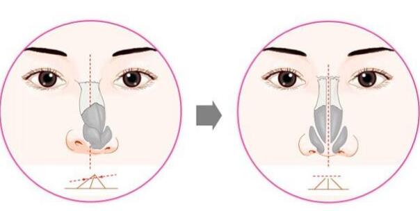 歪鼻矫正需要对鼻部进行测量吗