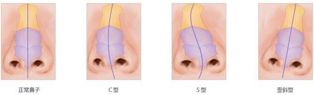 歪鼻矫正的手术切口怎么样
