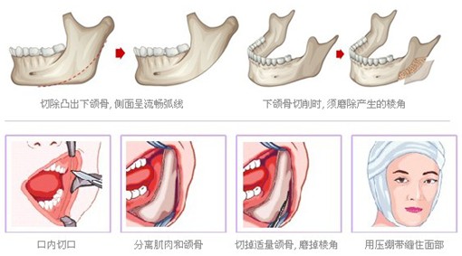 下颌角尊龙凯时的切口需要做多大