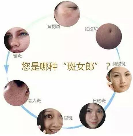 斑女郎的划分，精准祛斑无烦恼