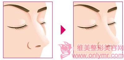 �շ�ǽ�����Ҫ���оֲ�������