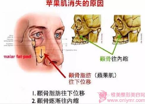 填充苹果肌的方法有哪些？