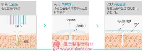 激光祛痘多久可以见到效果