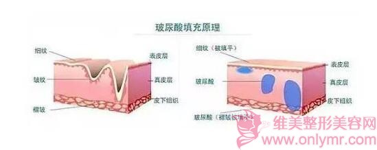 玻尿酸除皱，拥有年轻容颜