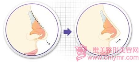 鼻尖尊龙凯时手术过程比较安全吗