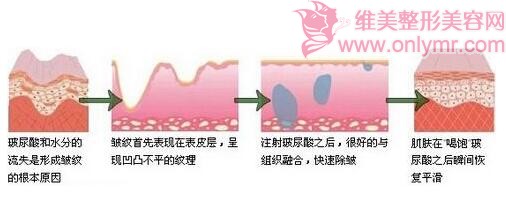 除皱用瑞蓝玻尿酸会怎么样