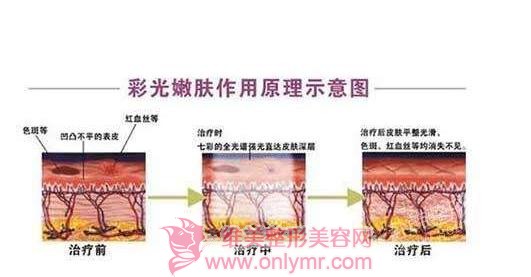 彩光嫩肤价格会影响到效果吗