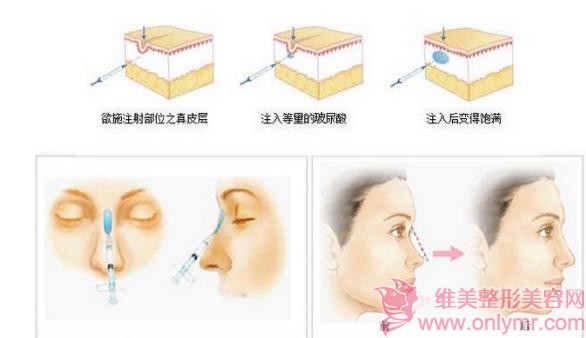 注射隆鼻后能否可以再隆鼻