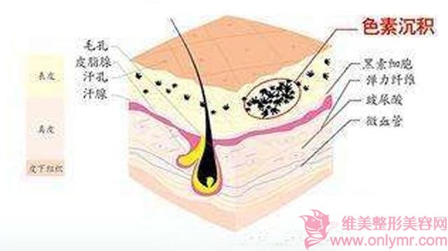 彩光祛斑效果与方法有关吗