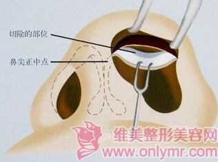 鼻孔缩小手术的切口比较隐蔽吗