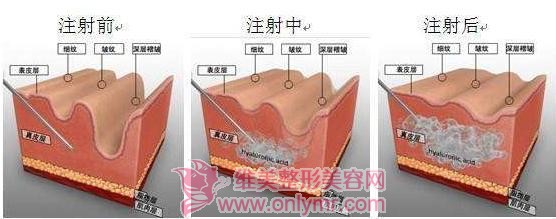 做伊维兰去抬头纹能永久吗