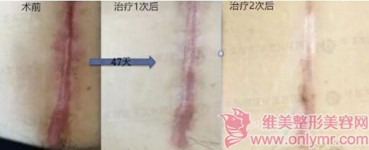 为什么疤痕在夏天越来越严重？要如何去掉疤痕