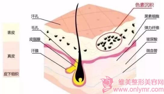 为什么疤痕在夏天越来越严重？要如何去掉疤痕