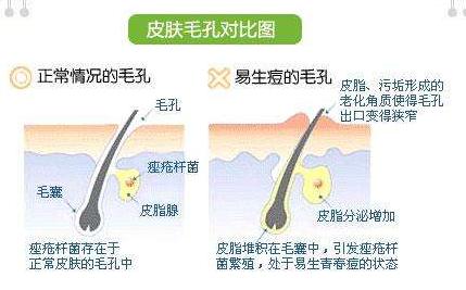 彩光嫩肤可以解决毛孔粗大问题吗