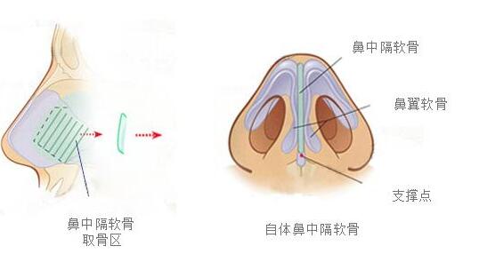 鼻尖尊龙凯时手术效果比较明显吗