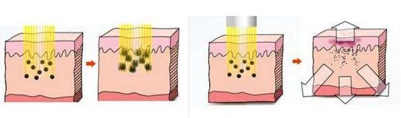 激光祛斑对皮肤有没有害