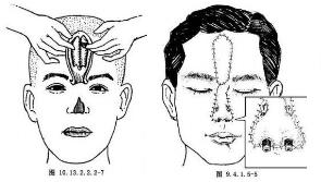 鼻再造术手术后可能会留疤吗