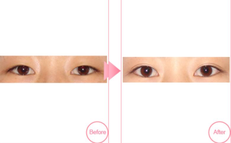 ����˫��Ƥ������������ѽ���۾���ı����