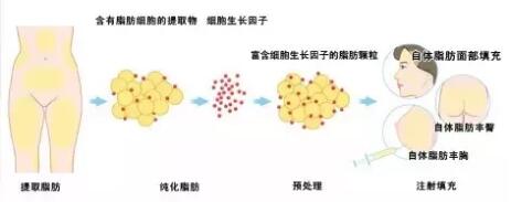 哪些人不适合做吸脂