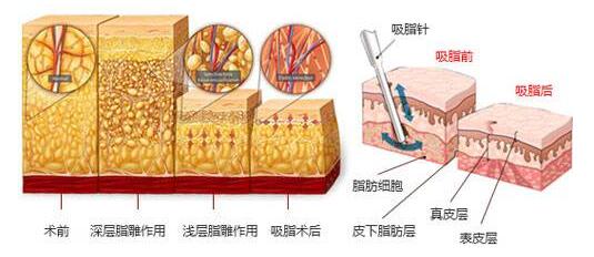 秋冬季节吸脂减肥好方法