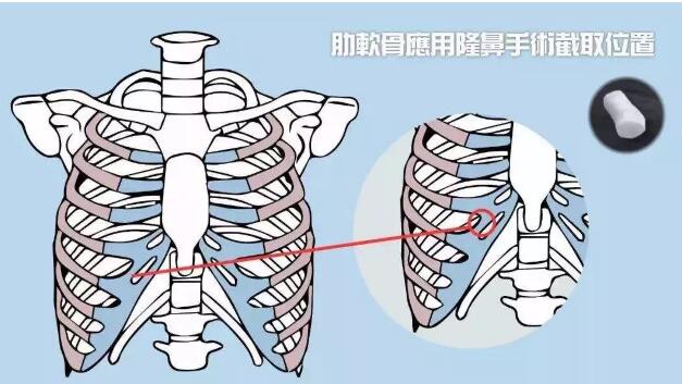 用男朋友肋软骨隆鼻的另类想法