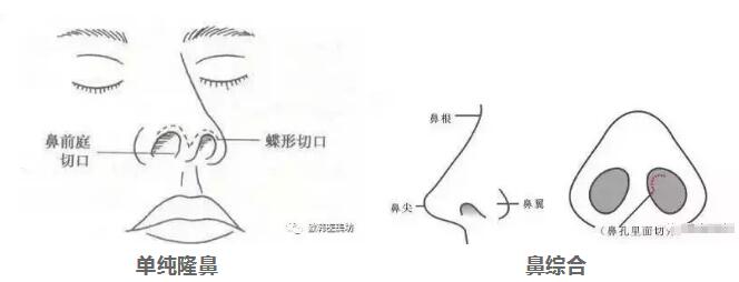 全新鼻部尊龙凯时方法诠释真正的美鼻