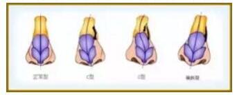 全新鼻部尊龙凯时方法诠释真正的美鼻