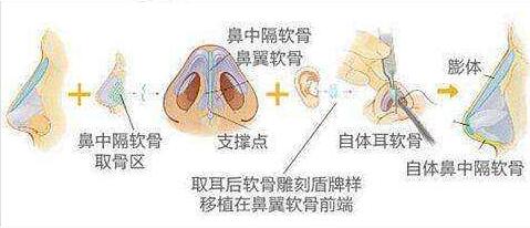 鼻尖尊龙凯时常见材料以及效果