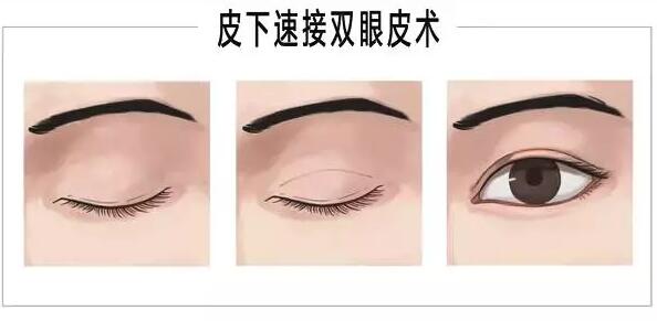 �������˽�˫��Ƥ�Ϳ��۽�