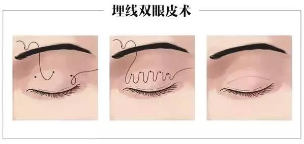 �������˽�˫��Ƥ�Ϳ��۽�